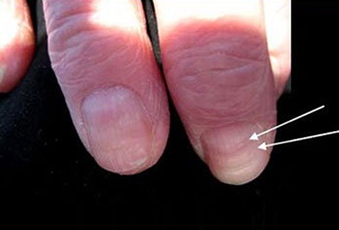 These unsightly lines may form in response to extreme cold, nail trauma, heart attack, or many other extreme stresses like syphilis, mumps, and pneumonia.