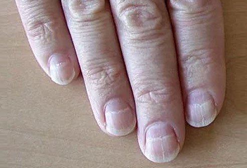 If your nails are crossed with one or more pale or white bands from side to side, you may have Muehrcke's lines.