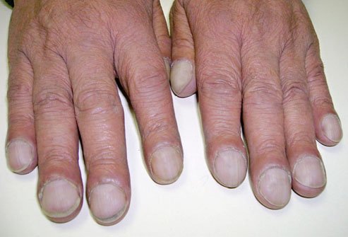Clubbed nails occur when the ends of your fingers or toes grow bulb-like.