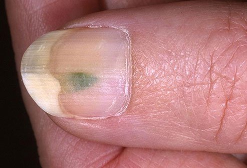 The green on your nails may be a splotch beneath the nail or you may find vivid, dark, completely green nails