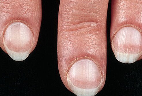Pale nails can indicate more serious health problems in some individuals.