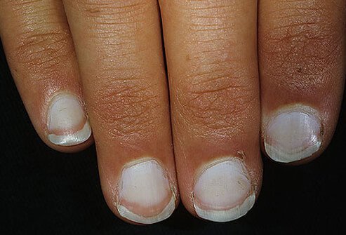 Although Terry's nail may suggest a serious condition, it can also appear in seniors as a normal part of aging.