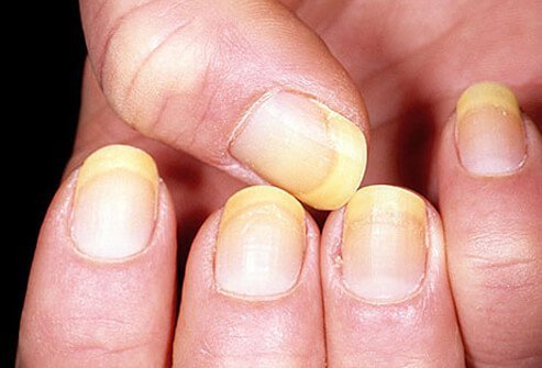 Example of yellow nails.