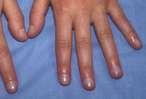Acute cyanosis can be a sign of a medical emergency.