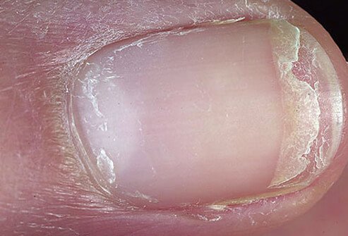 It may be difficult to treat your nails by the time they begin splitting and cracking.