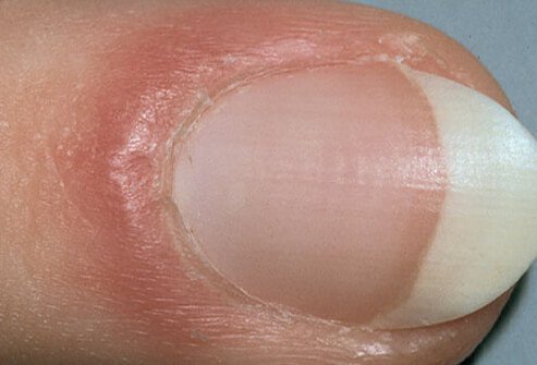 Example of inflammation causing a puffy nail fold.