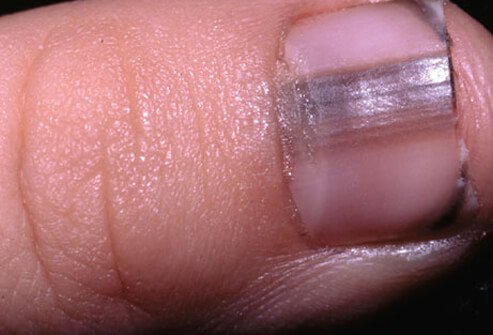 A biopsy may be necessary to rule out skin cancer.