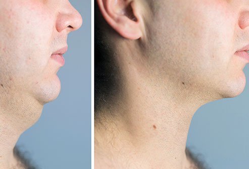 The cost of neck lift surgery may vary depending on various factors