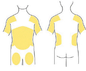 Patch application area - Illustration Patch application area - Illustration