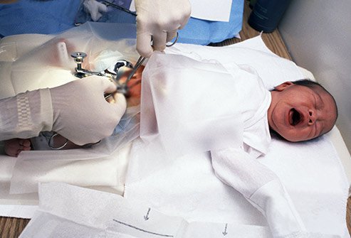 Circumcision, the surgical removal of the foreskin of the penis, is usually performed with local anesthesia in newborns, but older children, adolescents and adults may require sedation.