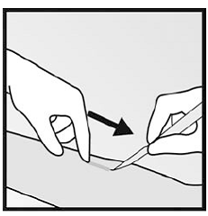 Push down the proximal end of the implant - Illustration Push down the proximal end of the implant - Illustration