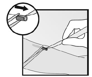If the implant is encapsulated, make an incision into the tissue sheath and then remove the implant - Illustration If the implant is encapsulated, make an incision into the tissue sheath and then remove the implant - Illustration