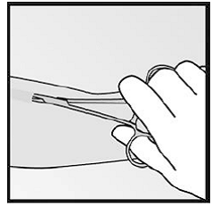 Carefully dissect the tissue around the implant and grasp the implant - Illustration Carefully dissect the tissue around the implant and grasp the implant - Illustration