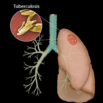 Picture of the lungs with bacterial tuberculosis infection.