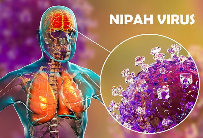 Nipah virus (NiV)