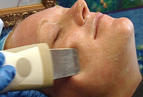 Microdermabrasion is a procedure whereby silicon crystals (grains of sand) are propelled by air onto the skin surface, producing a small amount of inflammation. 