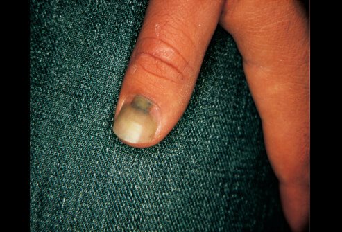 Picture of Onycholysis