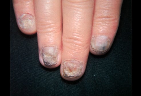 Picture of Ringworm Tinea Unguium (Onychomycosis)