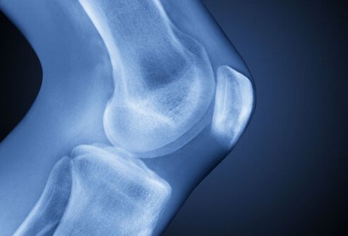 Osteoarthritis is a progressive form of arthritis characterized by breakdown of the cartilage in joints.