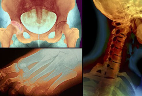 Osteoarthritis is common in large weight-bearing joints such as the knees, hips, and spine.
