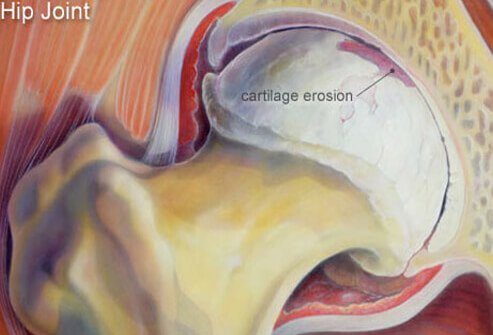 Osteoarthritis is most commonly a result of aging cartilage.