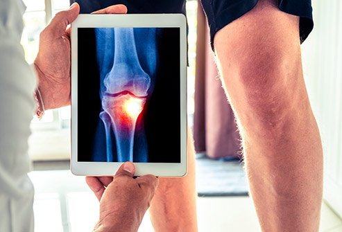 There are four stages of knee osteoarthritis.