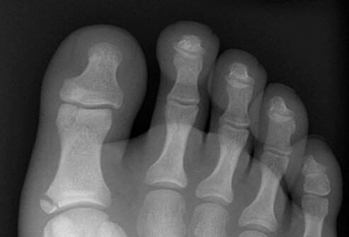 Fractures, foot. Two fractures of the proximal phalanx of the great toe. The fracture at the base is obvious, but the fracture at the head is more subtle.