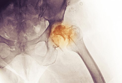 X-ray of the hip and pelvis of an 83 year old woman with a history of degenerative joint disease. The x-ray shows severe DJD of the hip as well as a fracture of the neck of the femur.