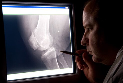 A doctor examines a bone X-ray.