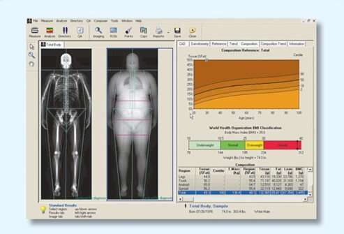 DXA computer scan.