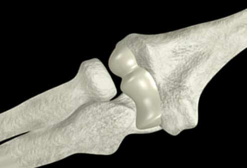 Illustration of the elbow bones.