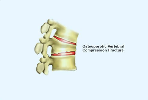 Osteoporotic Vertebral Compression Fracture.
