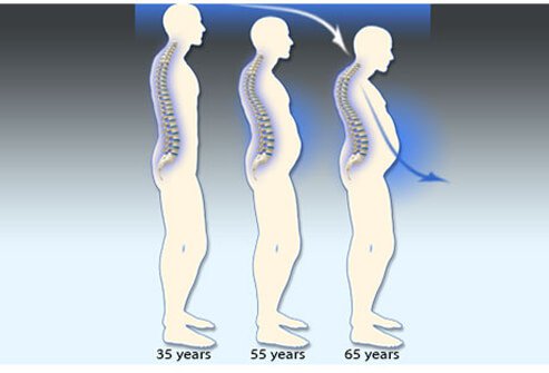 This illustration shows gradual progression of bone density deterioration after the age of 35.