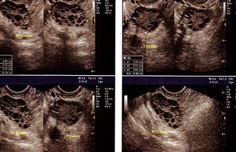 Ovarian cysts can be diagnosed a few different ways.