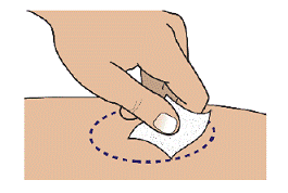 Clean the chosen site with an alcohol pad. Let the skin air dry for at least 10 seconds before injecting Palynziq - Illustration