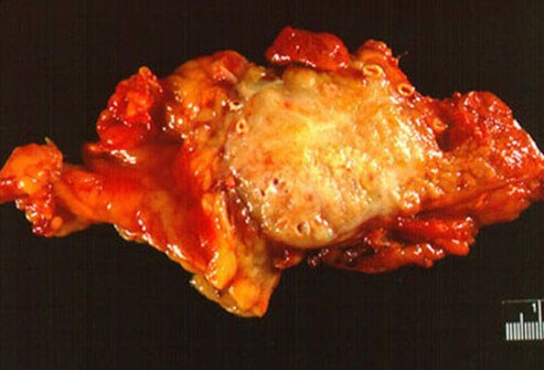 This is a gross section of a malignant tumor of the pancreas resected from the pancreatic body and tail.