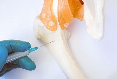 Paracentesis is a procedure for removing fluid from a body cavity or a cyst with a hollow needle or catheter. Paracentesis commonly refers to peritoneocentesis, which is removal of fluid from the abdominal (peritoneal) cavity. Paracentesis of the chest cavity is known as thoracentesis.