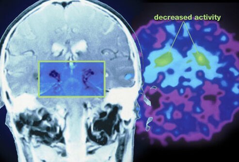 Parkinson's disease is usually slowly progressive over time (years).