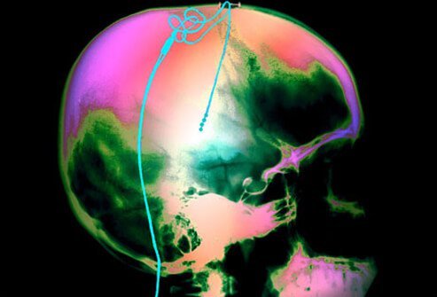 Another treatment method, usually attempted as effectiveness of medical treatments for Parkinson's disease wane, is termed deep brain stimulation.