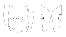 You can inject PEGASYS under the skin on your stomach or thigh - Illustration