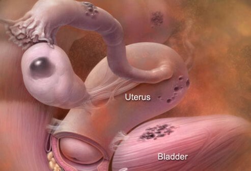 This tissue may attach to many other organs such as the bladder or intestines or even reproductive organs like the ovaries.