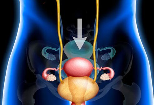 Pelvic prolapse is a condition where a pelvic organ such as the bladder or uterus drops into a lower than normal position.