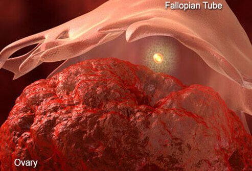 This pain occurs just prior to, and during ovulation.