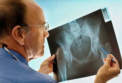 Although bone loss is common prior to menopause, exercise can help.