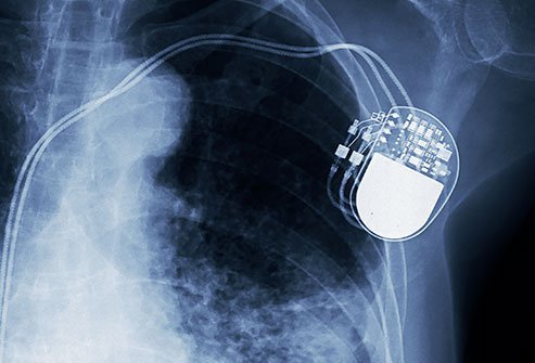 Pacemakers are generally safe