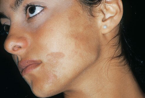 Picture of phytophotodermatitis hyperpigmentation