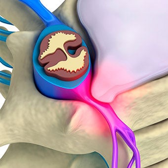An illustration of a pinched spinal nerve.