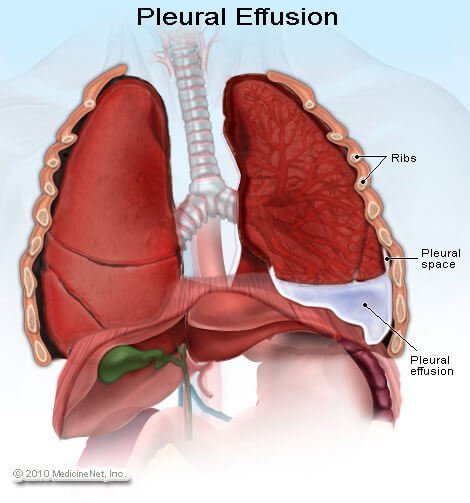 Picture of pleural effusion