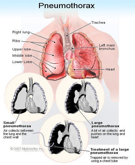 Picture of Pneumothorax (Collapsed Lung)