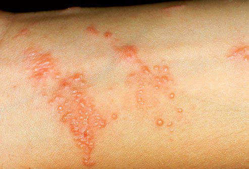 A rash from poison ivy, oak, or sumac looks like patches or streaks of red, raised blisters.